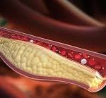 ব্যাড কোলেস্টেরল কী করতে পারে