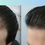 হেয়ার ট্রান্সপ্লান্ট ও পার্শ্বপ্রতিক্রিয়া